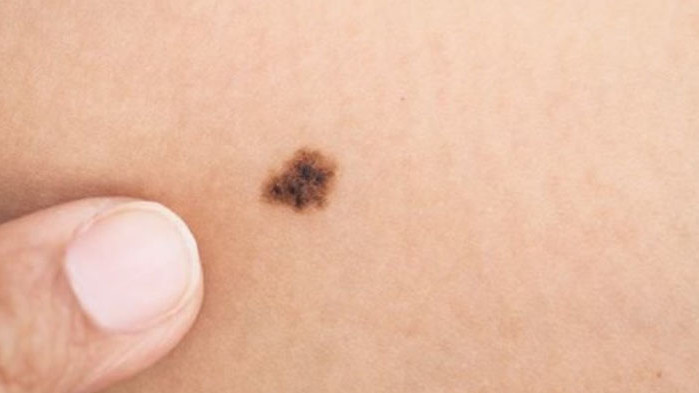 Меланомът и други подобни злокачествени образувания на кожата са най-често